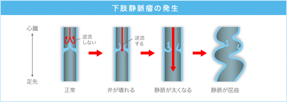 下肢静脈瘤の発生